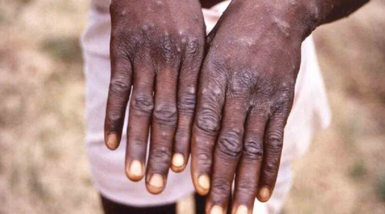 Francia y Alemania confirman primeros casos de viruela del mono